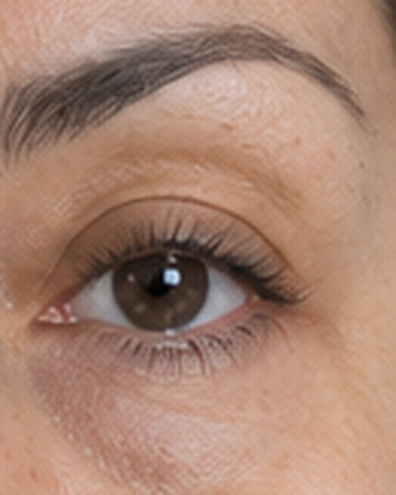 Blefaroplastia, comparación
