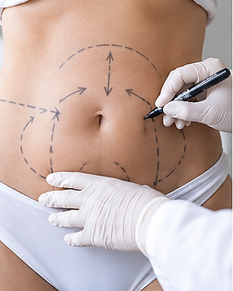 Lipoescultura, comparación